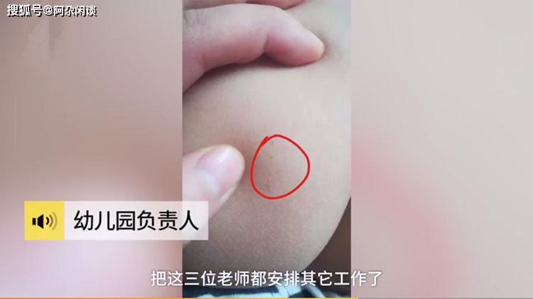 孩子身上的针眼 5534339ac4ca4123b70c85c36cc22636.jpeg