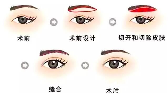 提眉术后多久可以洗脸?提眉后注意事项你了解吗?