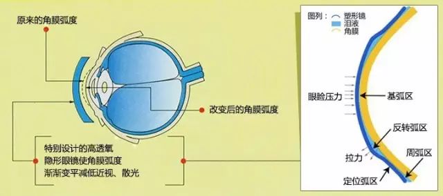 塑形镜的原理_△角膜塑形镜视力矫正原理(2)