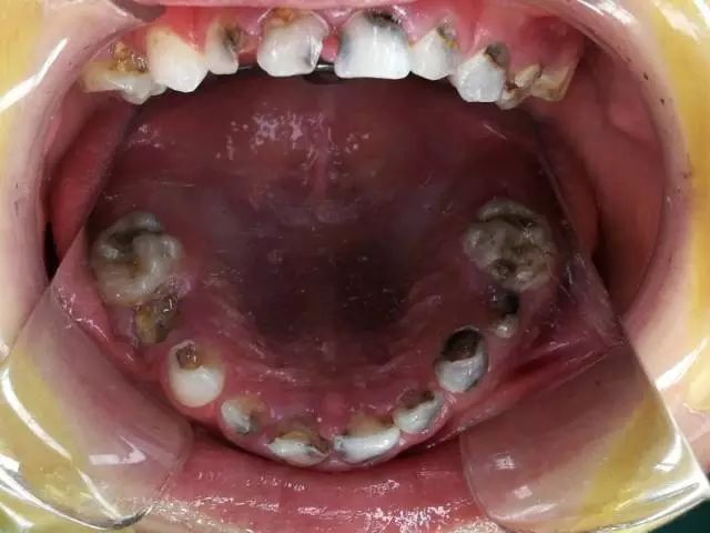 家有小宝■100名中国宝宝中，70个孩子有虫牙！宝宝长虫牙，多数都与家长这些习惯有关！