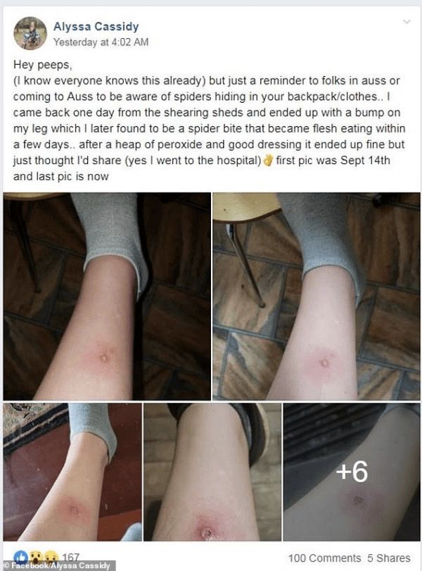 22岁女子来澳旅游被蜘蛛咬伤,医院检查吓一跳:轻则残疾,重则丢命