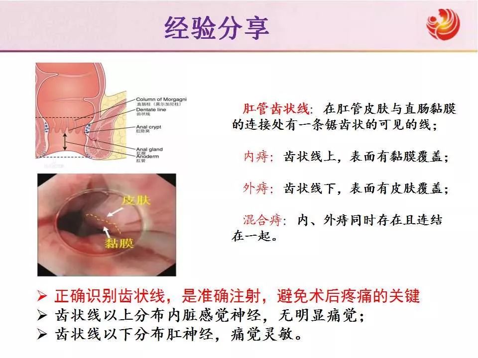 教学ppt内痔的内镜下硬化治疗经验分享