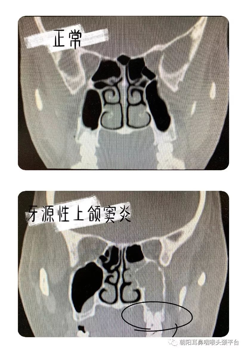 牙源性上颌窦炎的临床诊断并不困难.