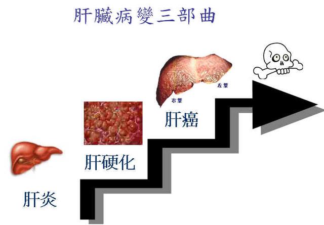 变成一个有着超大肚子,但四肢却瘦弱的肝硬化失代偿期患者的典型表现