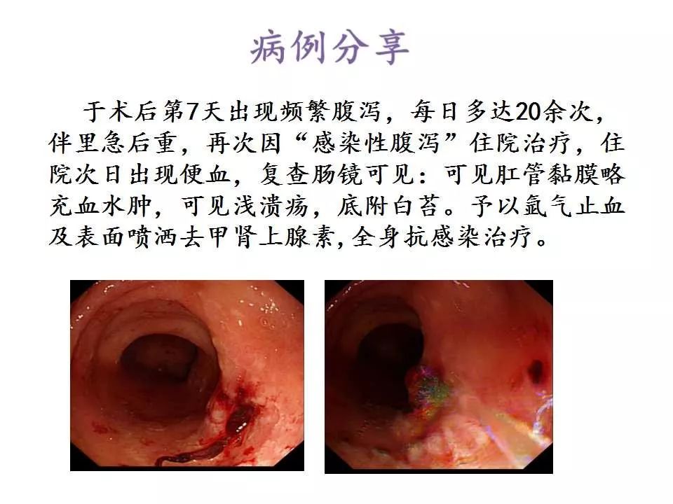 教学ppt内痔的内镜下硬化治疗经验分享