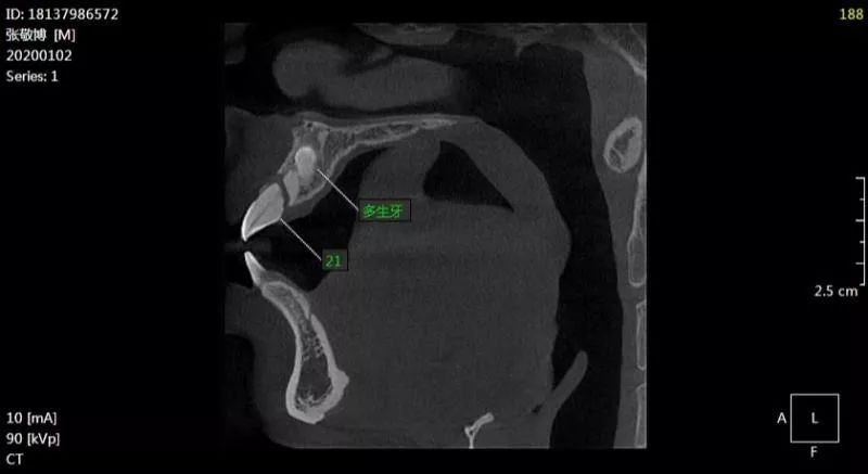 1/3折断移位,i 度松动,21根尖可见倒置多生牙 ,牙冠近中压迫至鼻腭管