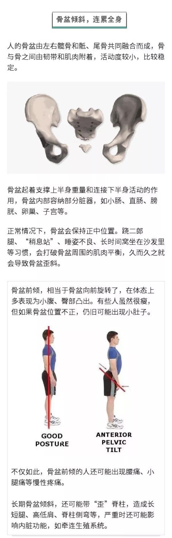 你这不是翘臀，这是骨盆前倾