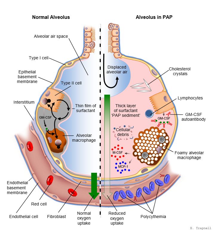 正常肺泡与pap患者肺泡的对比示意图(图片来源:参考资料[2])