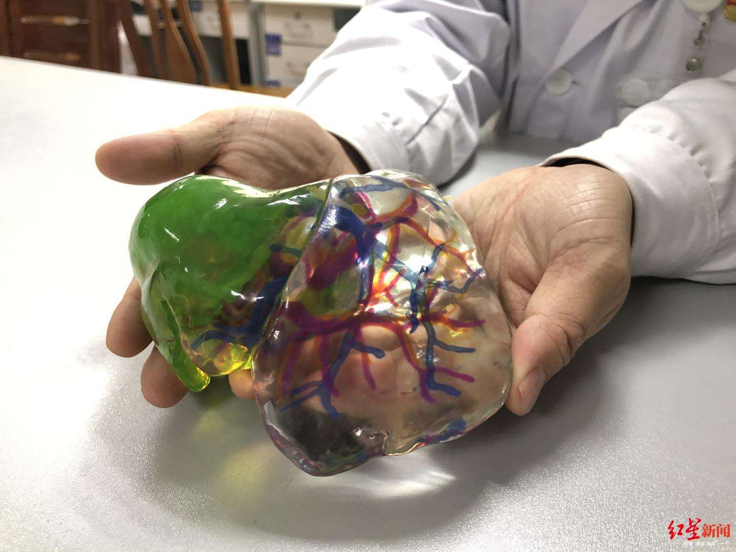 做超高难度的肝脏手术怕"陷阱?3d打印精准规划巧避"险"