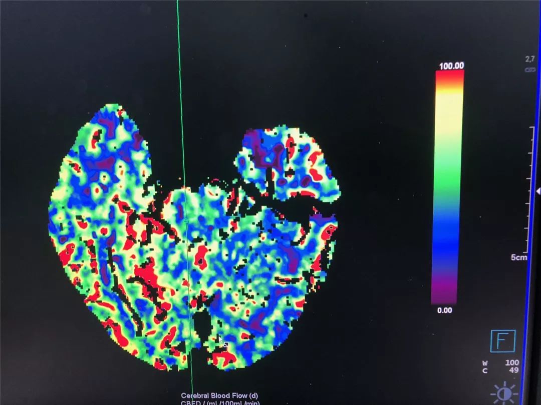 【请您关注】总院云影像中心顺利开展ct脑灌注成像检查