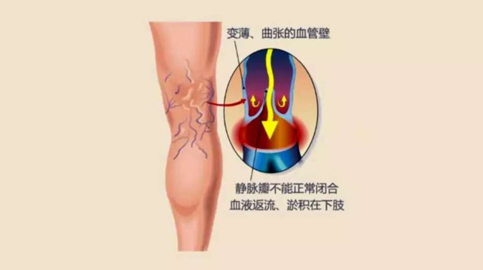 啥叫静脉曲张图片 26413c3575b44deba8e64a72b8d0f331.png
