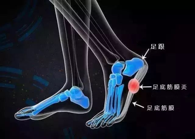 足底筋膜炎的  典型症状,  通常是在后脚跟骨的筋膜底部,有如刀割般