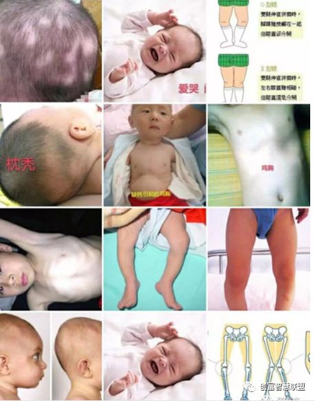 小孩子缺锌钙的表现 e97cb2afc5bc47f9b4a7123ee493792e.jpeg