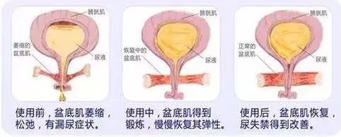 女性盆底肌有多重要,你一定要知道!