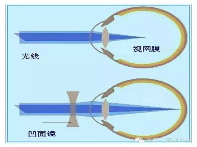 请问近视利用什么的原理制成的_预防近视手抄报