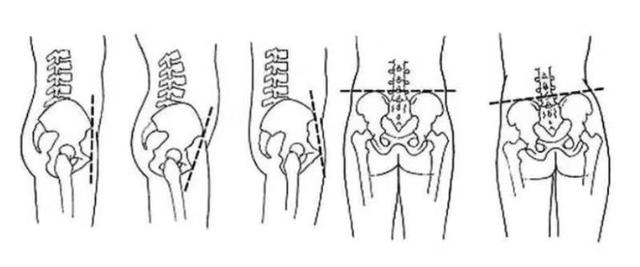 第4点,自己用手摸一下两侧骨盆高低不一样