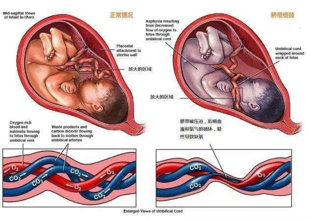 32周胎儿绕颈一周怎么办