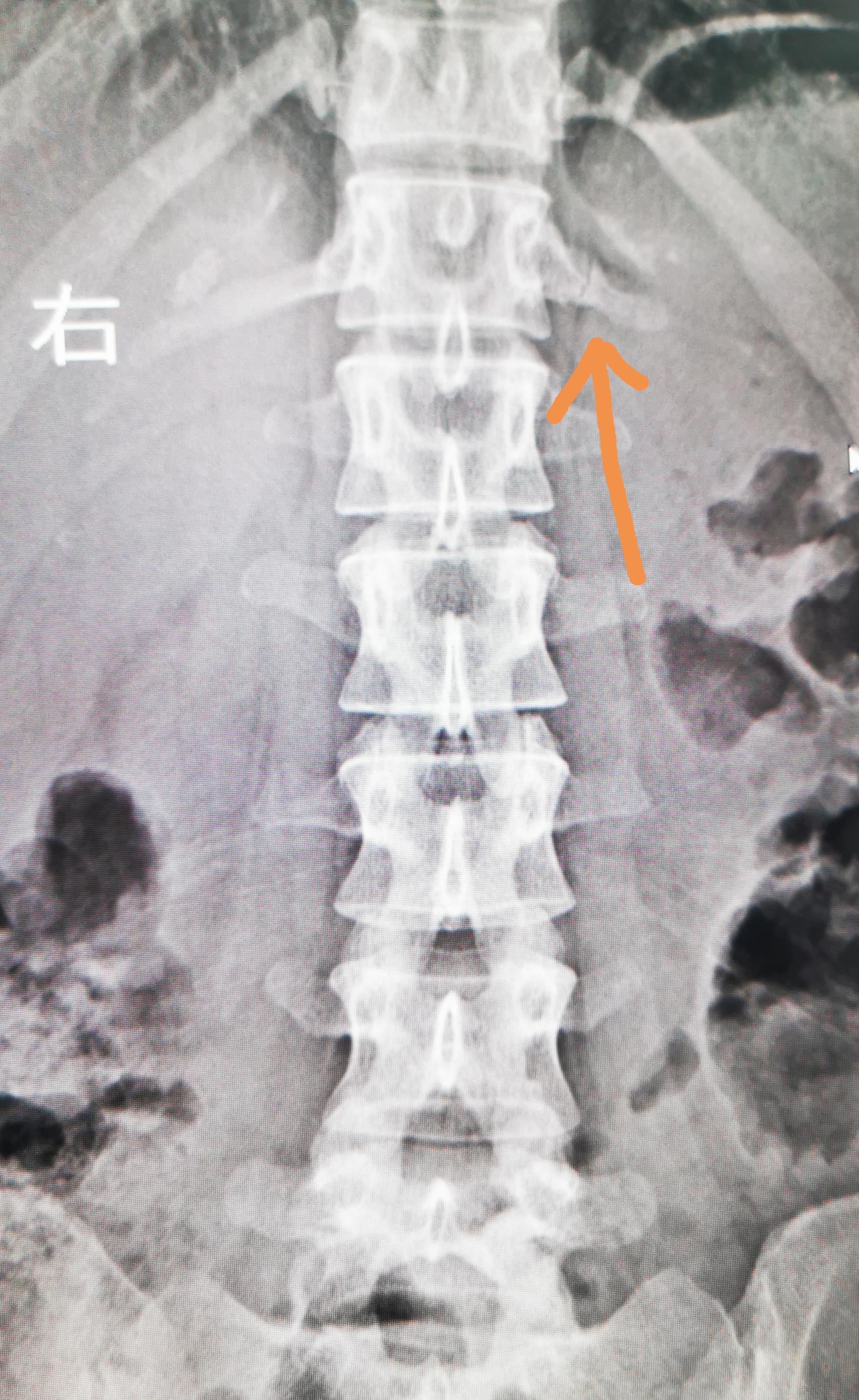 骶尾椎侧位置示意图,正常人尾椎骨光片图,正常骶尾骨线图片(第2页)_大山谷图库