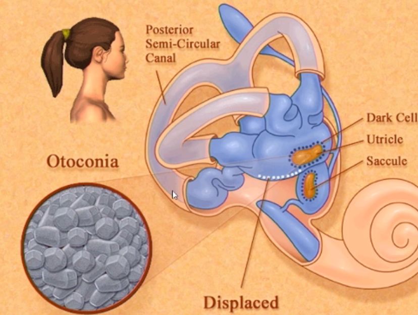 我晕!折腾人死去活来的眩晕 ,竟是耳石惹的祸,咋办?
