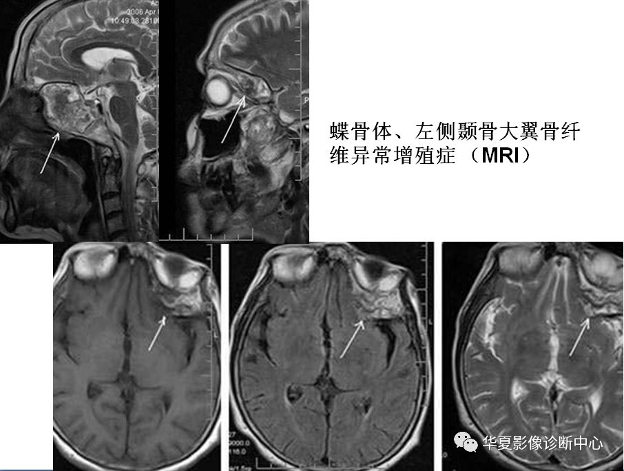 颅骨良性肿瘤的影像诊断