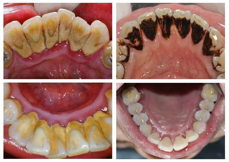 提问|牙结石为什么会长在牙龈下面?