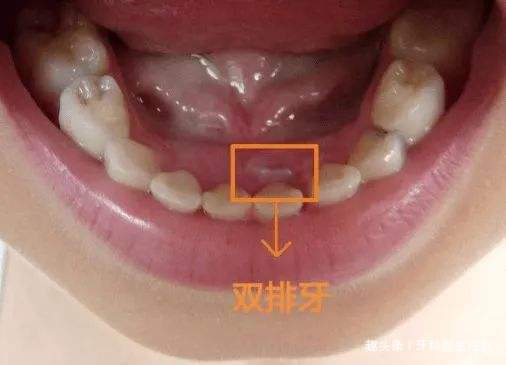 小孩牙齿不掉怎么办