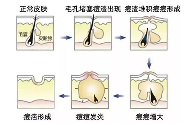 痘痘毛孔的清道夫一撕一拉红肿的痘痘一晚上就瘪了