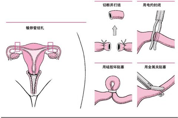 男性结扎的原理_男性结扎原理:切断输精管(2)