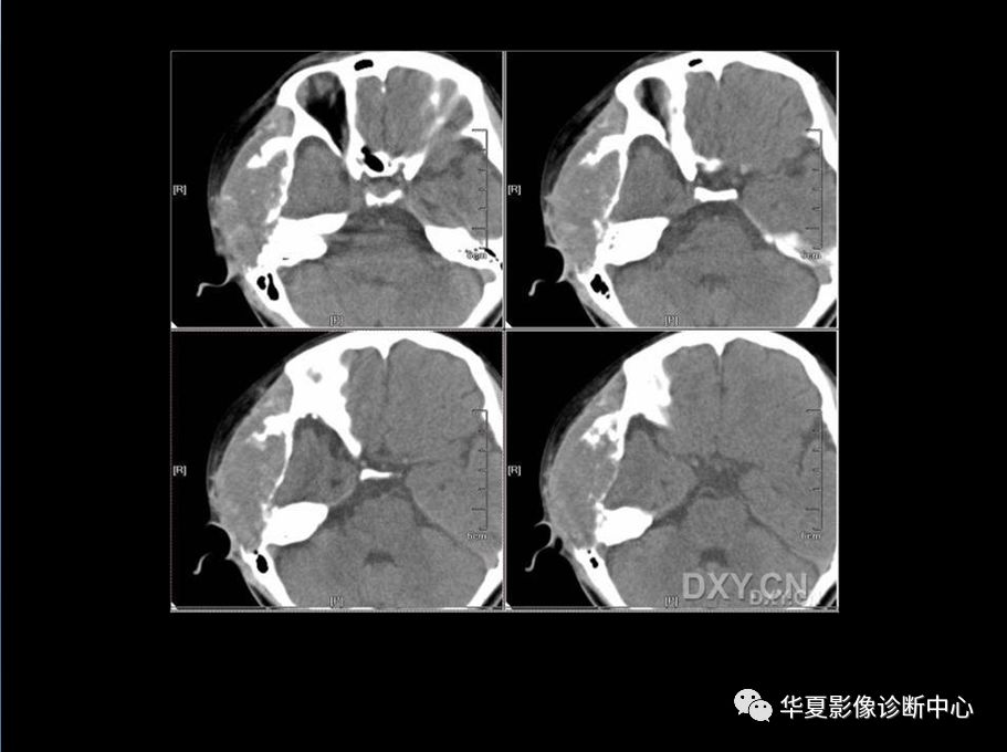 颅骨良性肿瘤的影像诊断