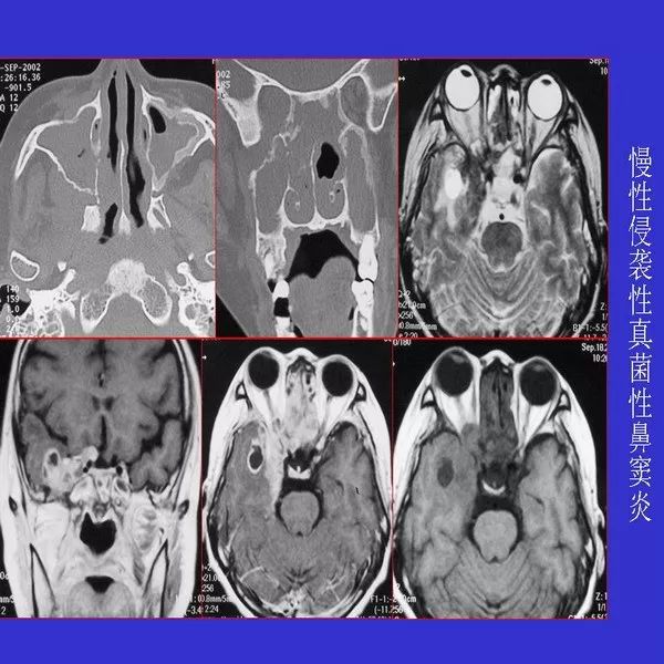 真菌性鼻窦炎影像学诊断