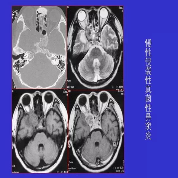 真菌性鼻窦炎影像学诊断