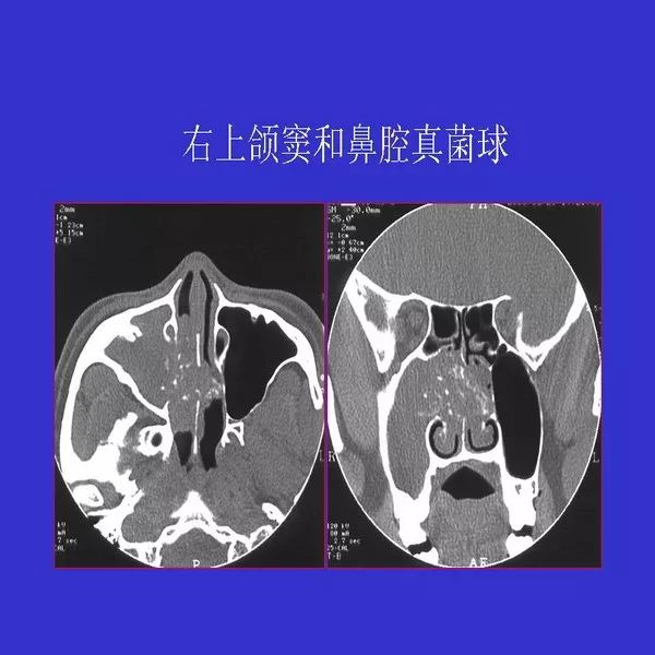 真菌性鼻窦炎影像学诊断