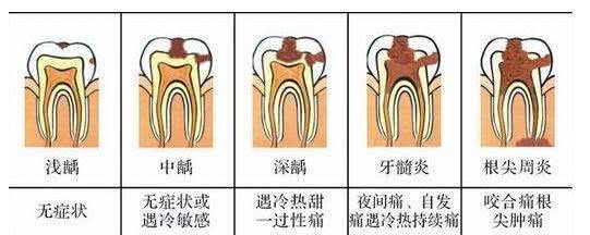 龋蚀破坏只在釉质内,一般无明显龋洞,除了可视的小黑点,完全没感觉.