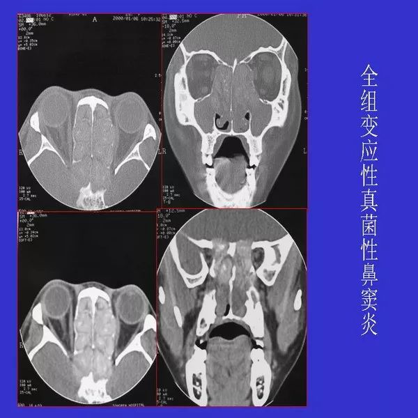 真菌性鼻窦炎影像学诊断