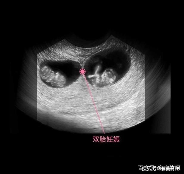 胎儿从卵泡到性别形成,17张图片清晰诠释,男宝女宝看得很清楚