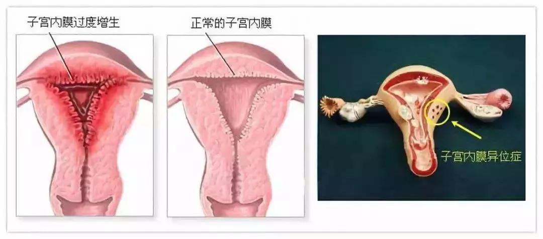 子宫内膜很"矫情",过薄或过厚都不利于怀孕,该怎么办?