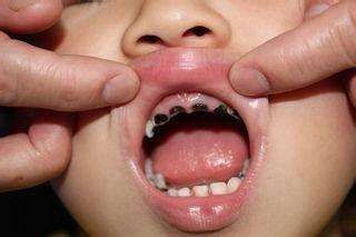 3~4岁的孩子就满口蛀牙,儿童蛀牙与饮食,以及个人卫生