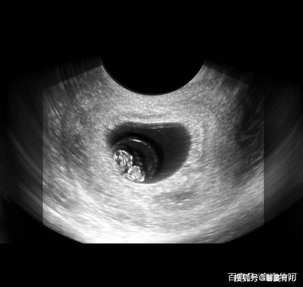 胎儿从卵泡到性别形成,17张图片清晰诠释,男宝女宝看得很清楚