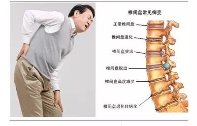 什么是坐骨神经痛腿疼 e7b6aa3681b448ae81333a76e16fe66f.jpeg