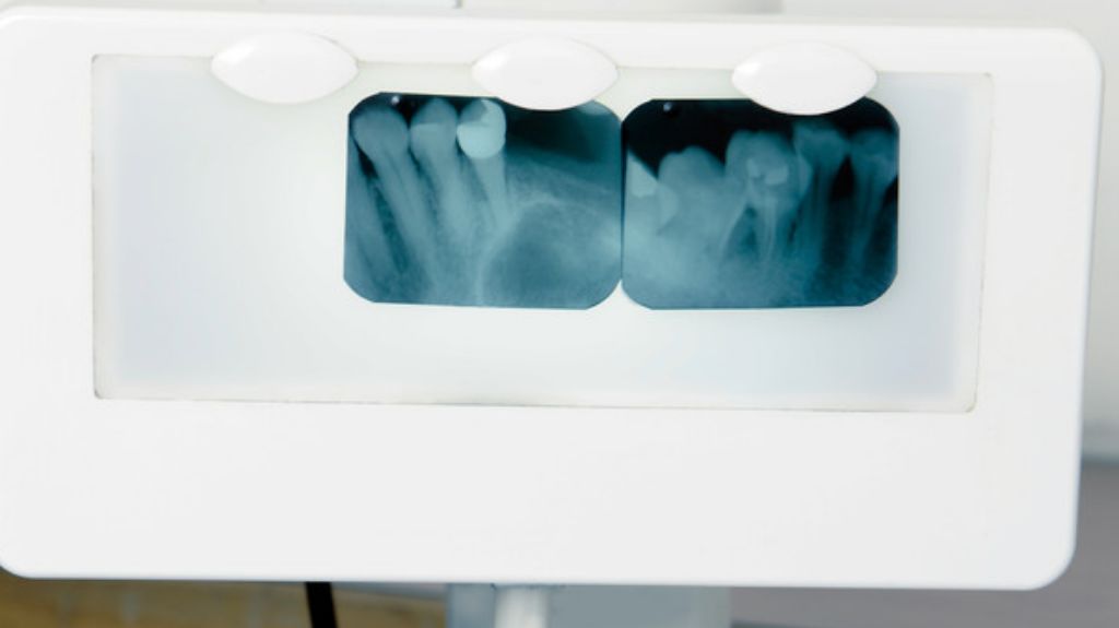 对牙医来说,最丢人的事就是:拔错牙
