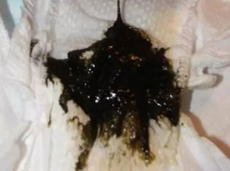 屎是怎么形成和排出的 09212b9d8a4b4b11b49167611e8412a4.jpeg