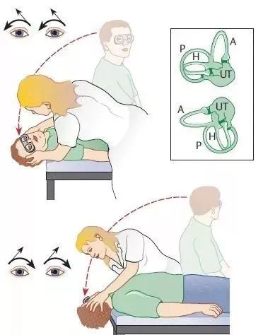 图文并茂:手把手教你诊治良性阵发性位置性眩晕(耳石症)丨临床必备