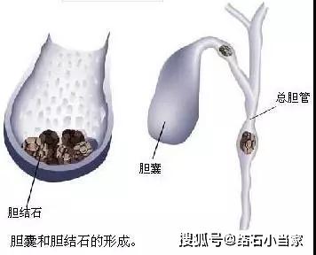 胆结石什么原因造成的呀 440a0271fc57425ca1d081c96413de10.jpeg