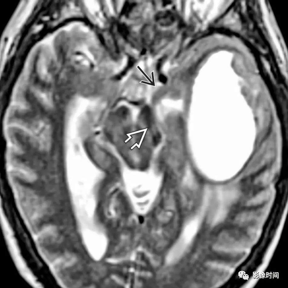 大脑脚右侧颞叶脑水肿继发中度小脑幕切迹疝鞍上池及四叠体池消失,中