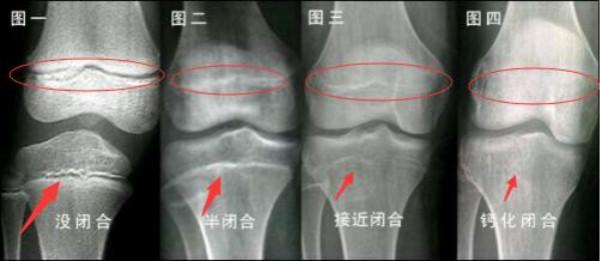 「母婴参考」孩子有五种迹象=身高马上“截停”，做好四件事，还能窜高10厘米