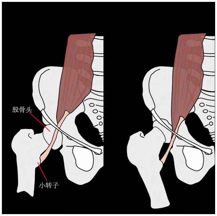 大腿根老是无缘无故的啪啪响原来是弹响髋惹的祸