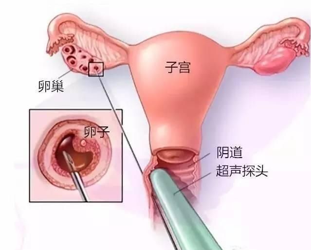 怎么样才能轻松取出针 8ced23ce5c4a42ee94644fc928559e5a.jpeg