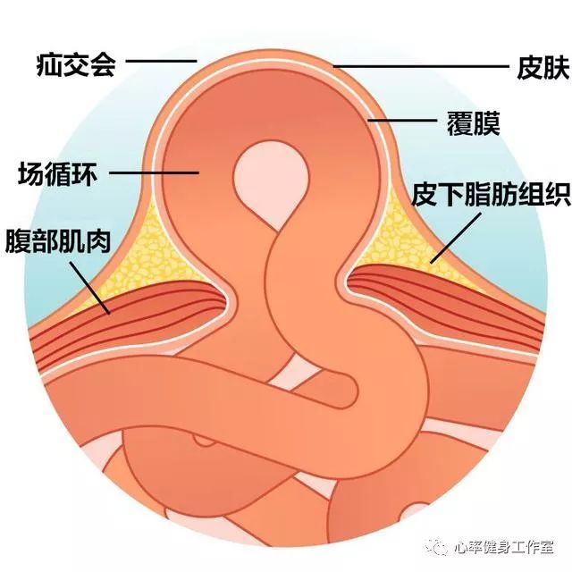 腹直肌分离三指以上的患者更容易出现小肠疝气等严重的问题.