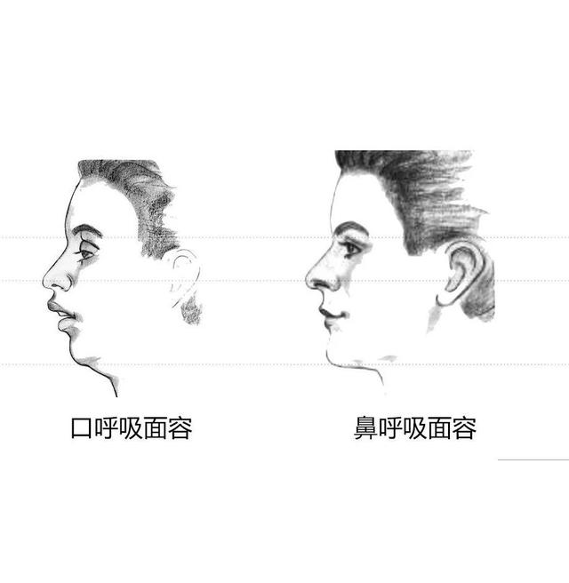 正美体态下巴后缩口呼吸口呼吸面容矫正