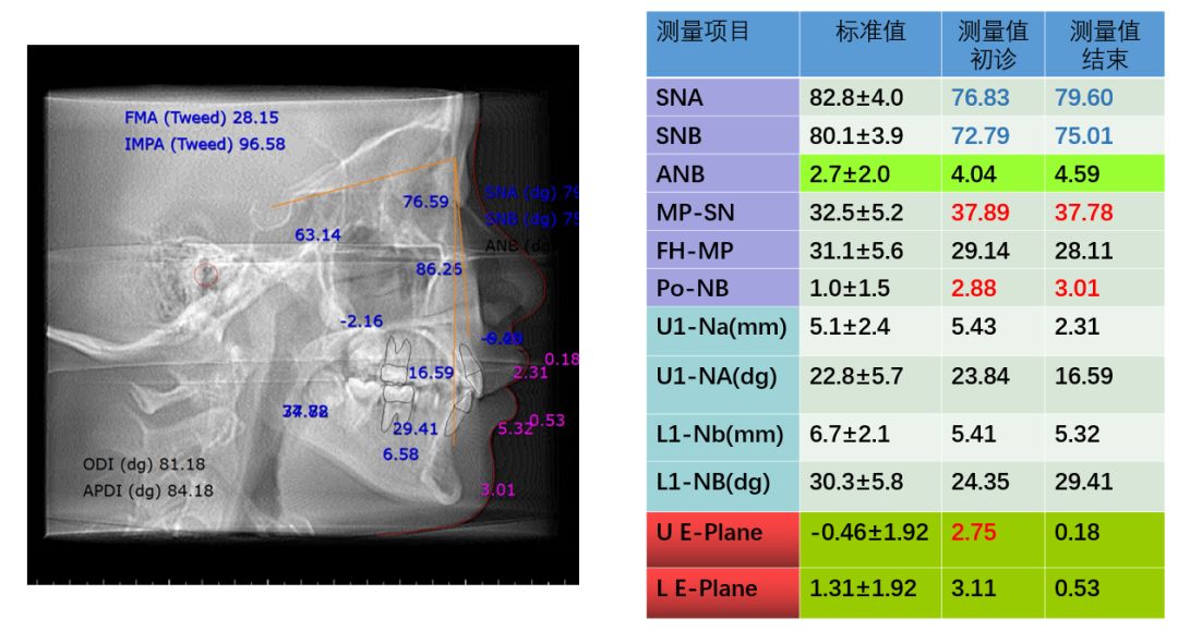 病例分享lorthguide03奥世美03数字正畸导航系统